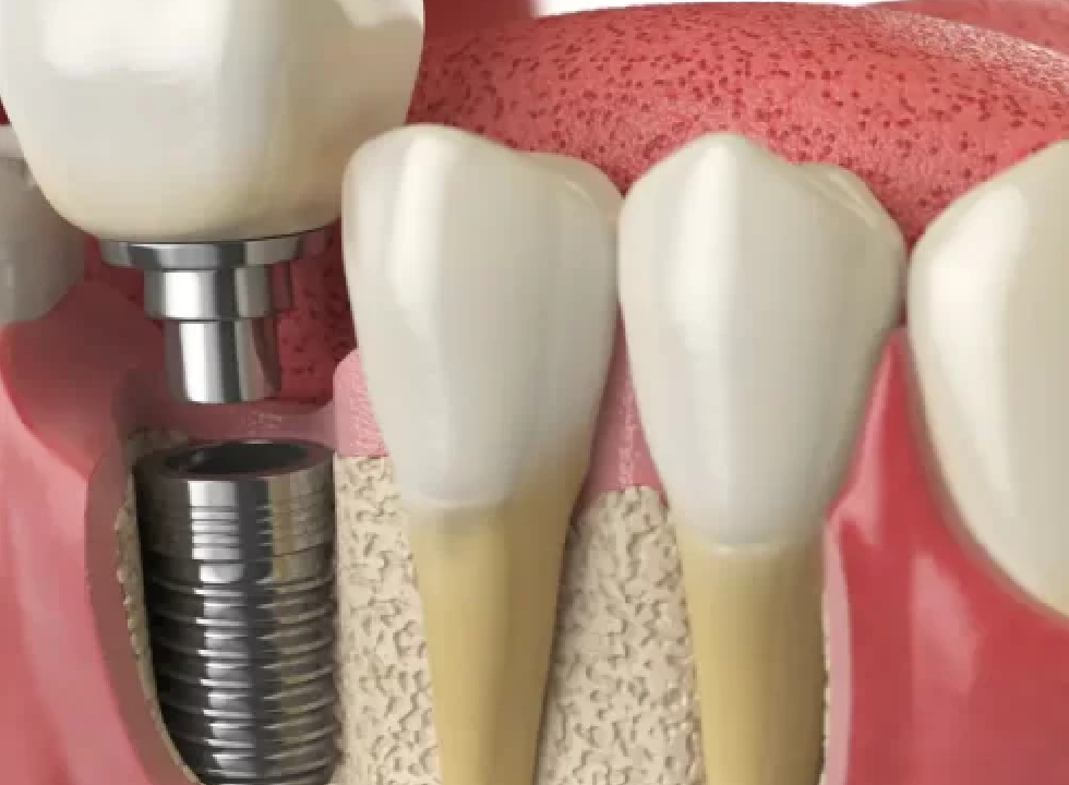 Are Dental Implants Right for You? A Comprehensive Assessment